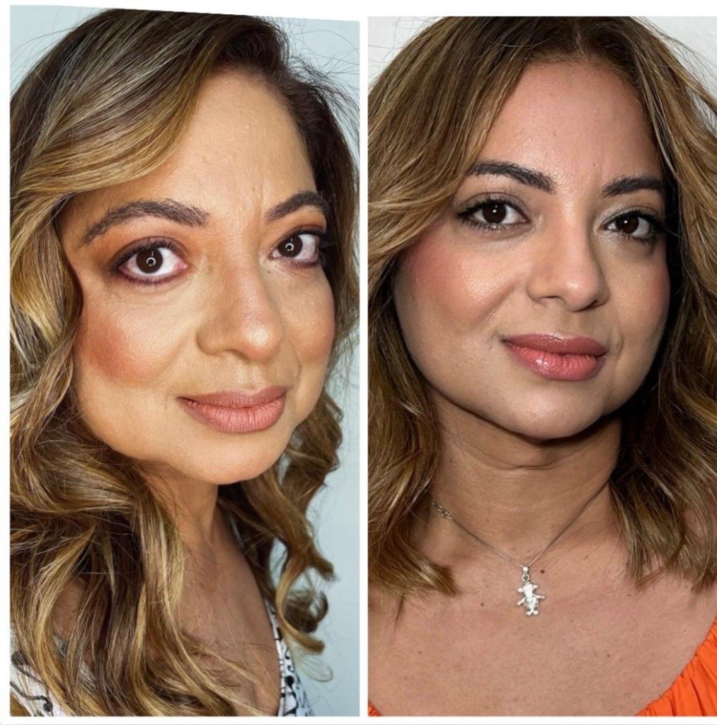 Bioestimuladores de Colágeno - Antes e Depois