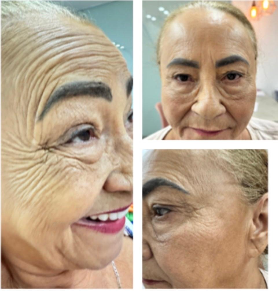 Botox Full Face - Antes e Depois