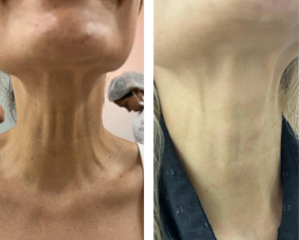 Botox Full Face Pescoço - Antes e Depois