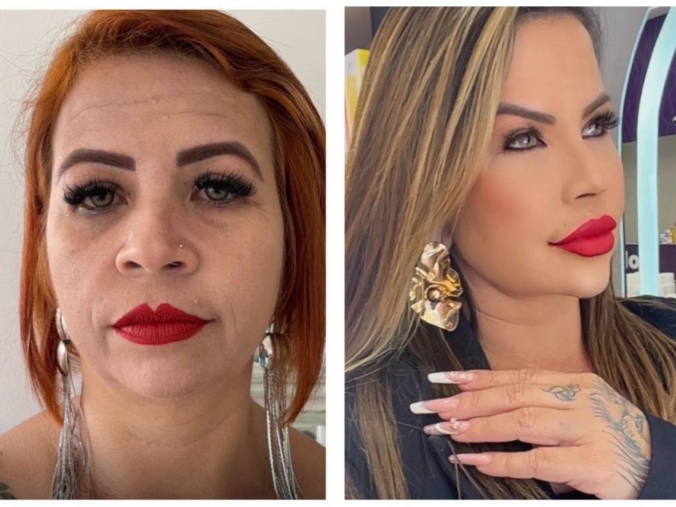 Harmonização Facial Feminina - Antes e Depois