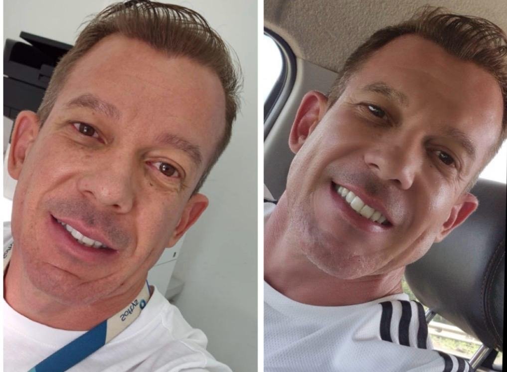 Harmonização Facial Masculina - Antes e Depois