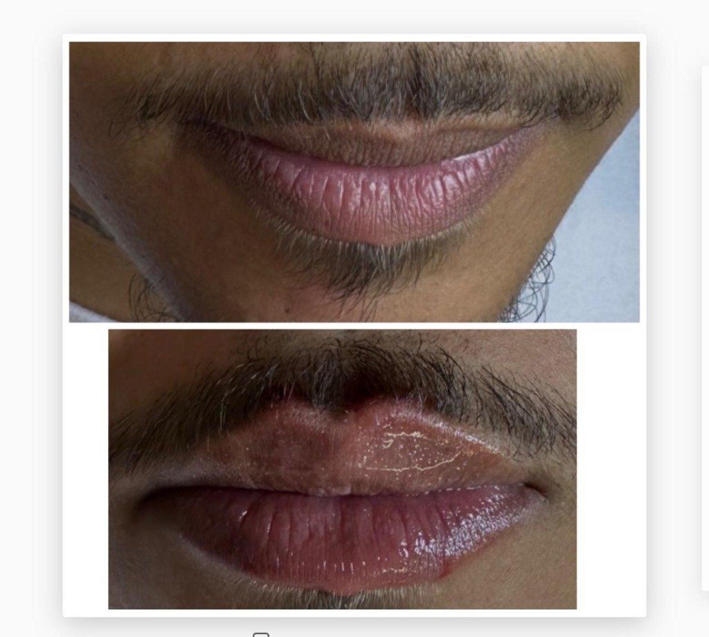 Preenchimento Labial Masculino - Antes e Depois