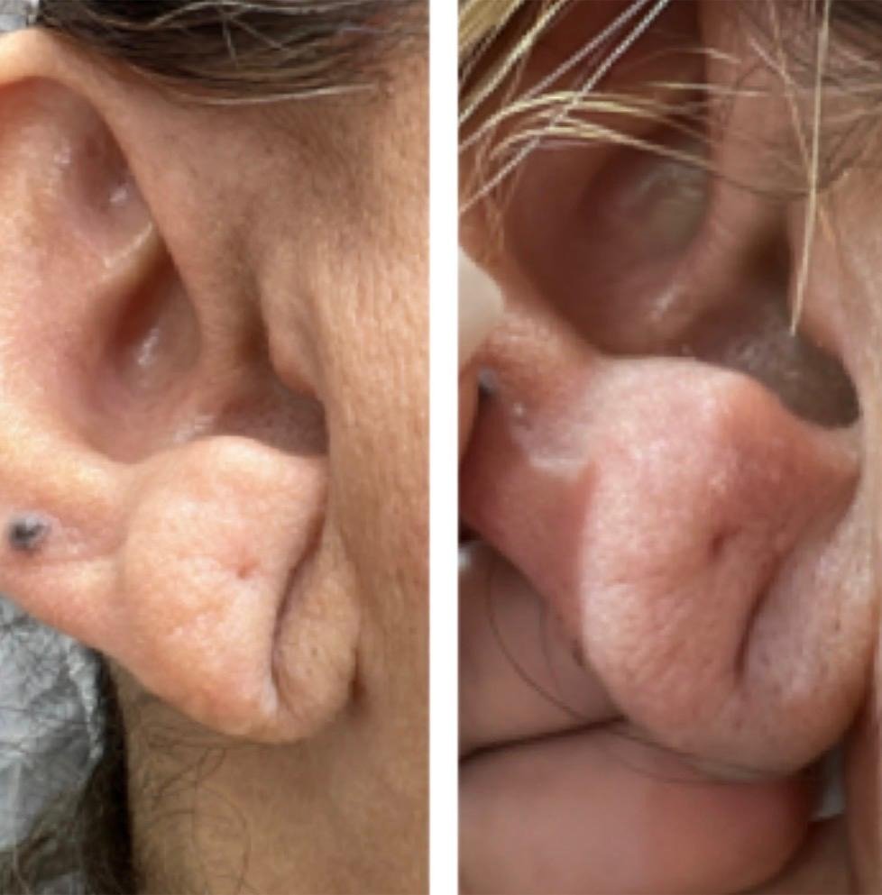 Preenchimento de Lobo de Orelha - Antes e Depois