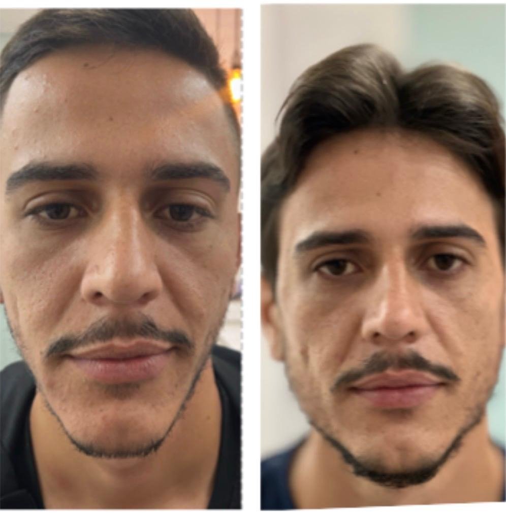 Visagismo e Harmonização Facial Masculina - Antes e Depois